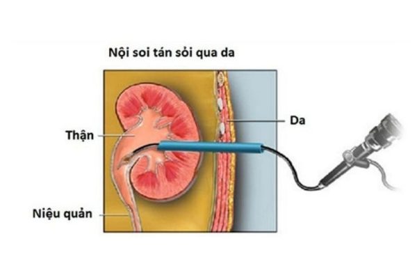 quy trinh tan soi than qua da 1