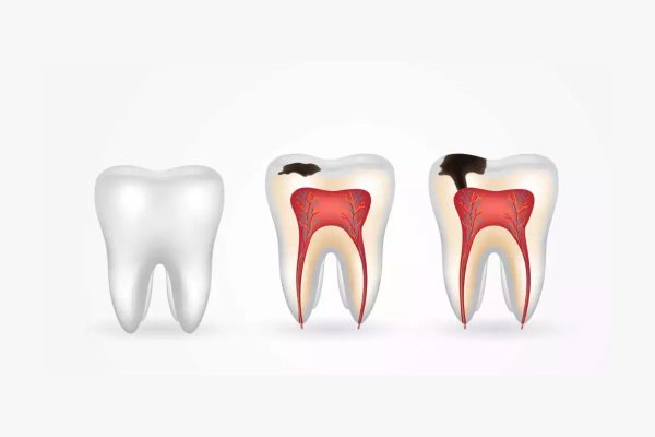Răng sâu càng nghiêm trọng thì vùng thương tổn càng lớn và có thể ảnh hưởng tới tủy răng