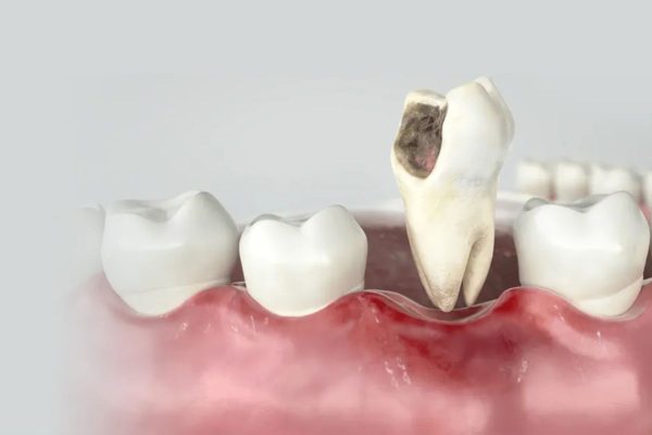 Răng bị sâu nặng nếu không được phát hiện và điều trị sớm có thể gây viêm nha chu, viêm tủy răng, mất răng...