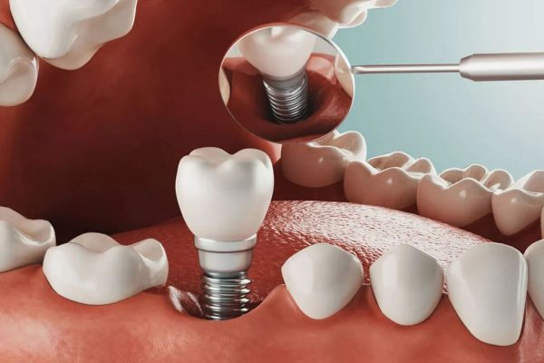 Phục hình implant là một trong những giải pháp thường được áp dụng để khắc phục răng sâu dẫn đến mất răng