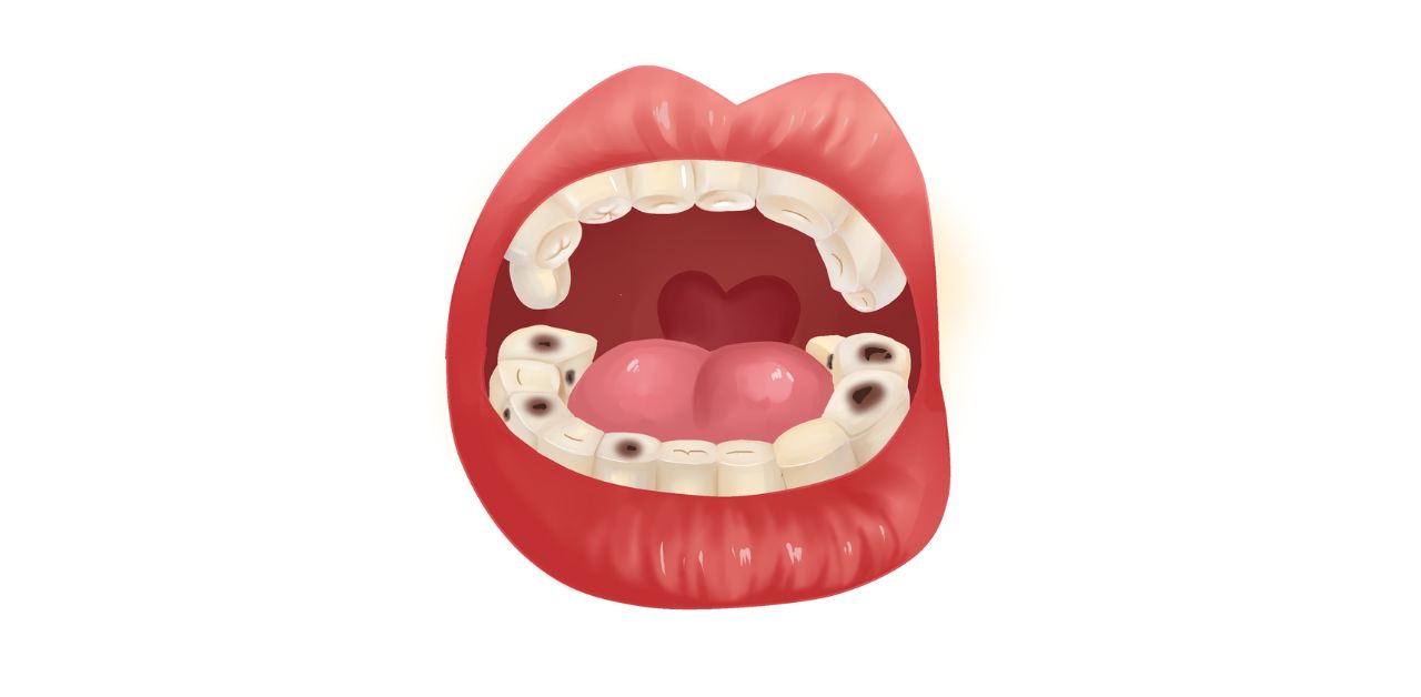 Nguyên nhân, triệu chứng và cách phòng ngừa sâu răng số 6 bị sâu cần biết