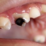 Sâu răng nặng và biến chứng đáng gờm – Viêm tủy!