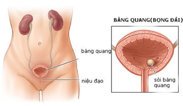 sieu am soi bang quang 2