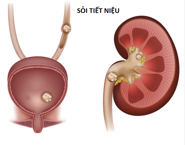 soi duong tiet nieu e1667382176784