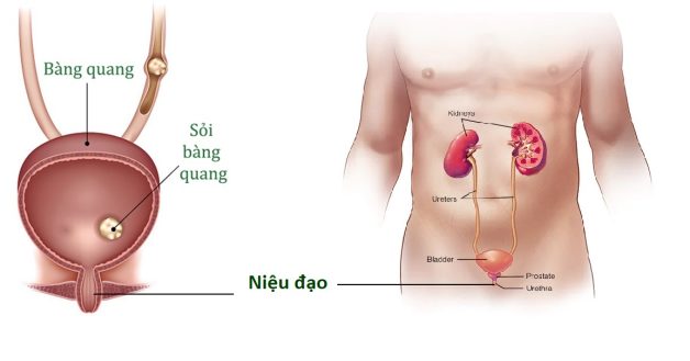 soi roi xuong nieu dao e1667381089574