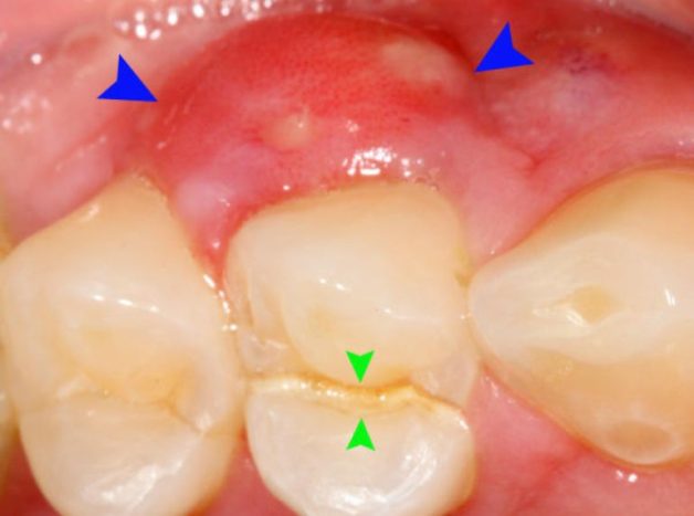 Sưng lợi răng hàm - biểu hiện của một số bệnh lý | TCI Hospital