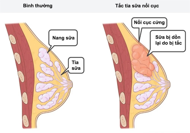 4. Các Phương Pháp Điều Trị Hỗ Trợ Tắc Sữa