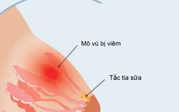 Tắc Tia Sữa Sốt: Nguyên Nhân, Triệu Chứng Và Cách Điều Trị Hiệu Quả