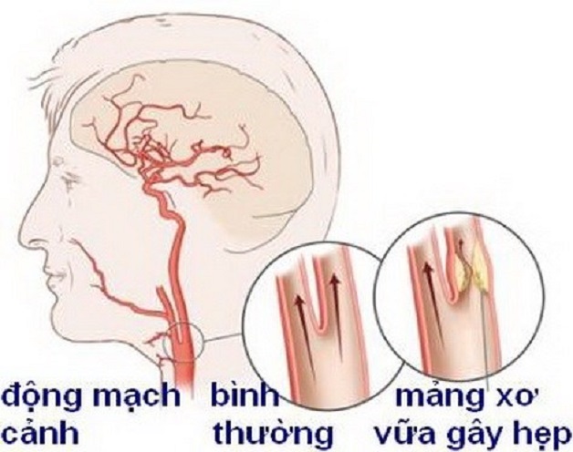 tai biến mạch máu não là gì? nguyên nhân gây tai biến mạch máu não