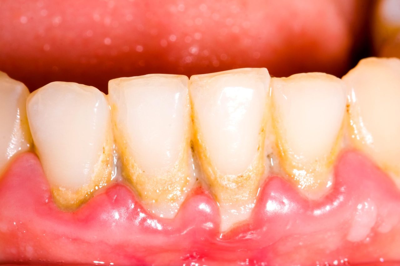 Một số phương pháp lấy cao răng bị chảy máu cần biết