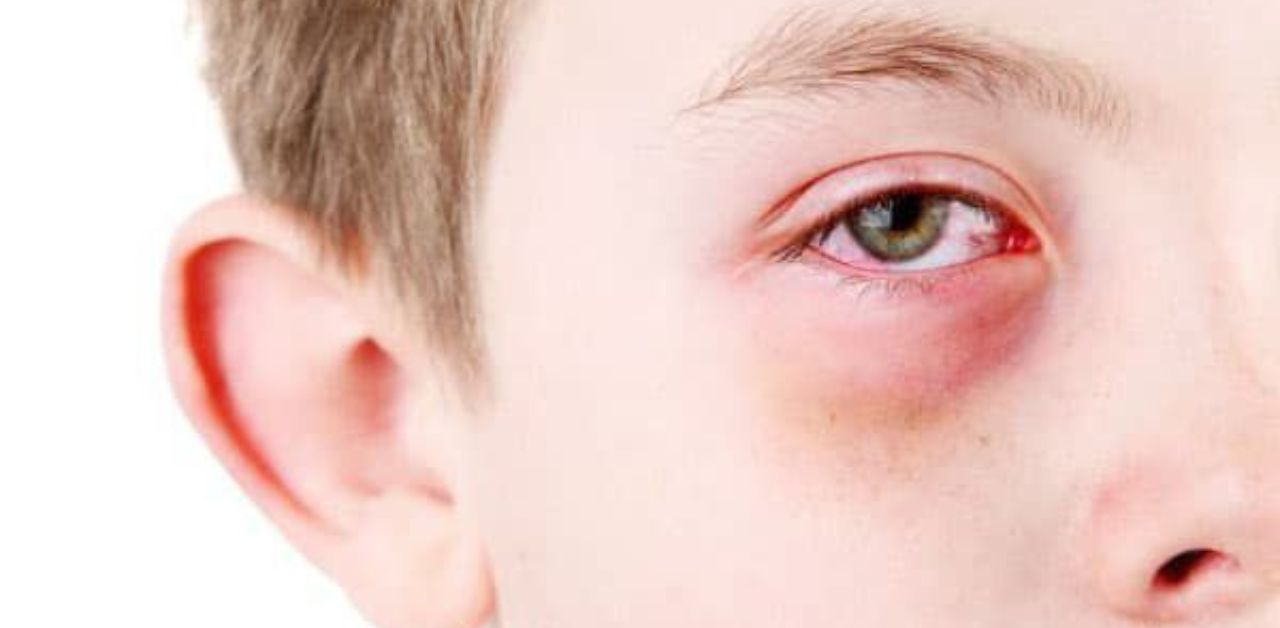 Lòng trắng của mắt sẽ chuyển sang màu gì khi trẻ em mắc viêm kết mạc?
