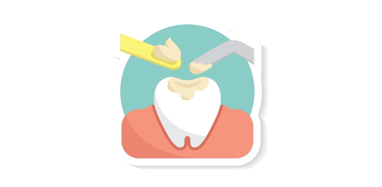 Vật liệu composite được sử dụng trong quá trình trám răng là gì?

