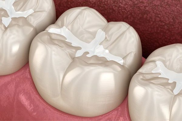 Composite là một loại nhựa tổng hợp được sử dụng trong lĩnh vực nha khoa để hàn trám răng 
