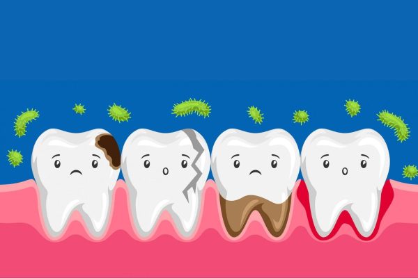Vi khuẩn là tác nhân chính dẫn tới sâu răng do chúng phát triển quá mức và gây ra quá trình hủy khoáng ở cấu trúc của răng
