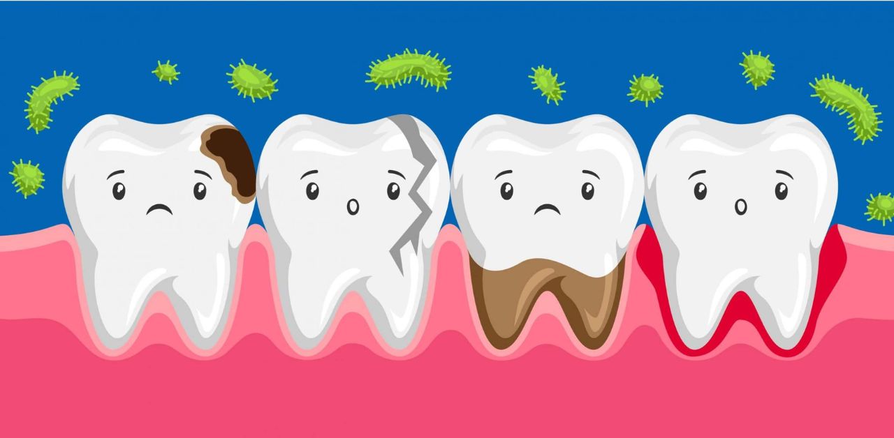 Thông tin về Sâu răng vĩnh viễn - Sinh hoạt hàng ngày và chăm sóc răng miệng