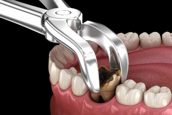Chỉ định nhổ răng trong trường hợp răng sâu nặng làm tổn thương tủy và chân răng