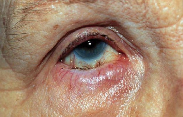 Lông mi mọc ngược vào trong, chà sát lên giác mạc là một giai đoạn phát triển của bệnh đau mắt hột