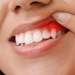 Nhận biết các triệu chứng viêm chân răng