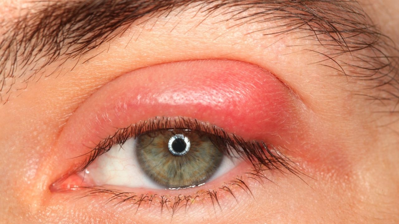 U nhú mi mắt có thể tái phát sau khi điều trị không?
