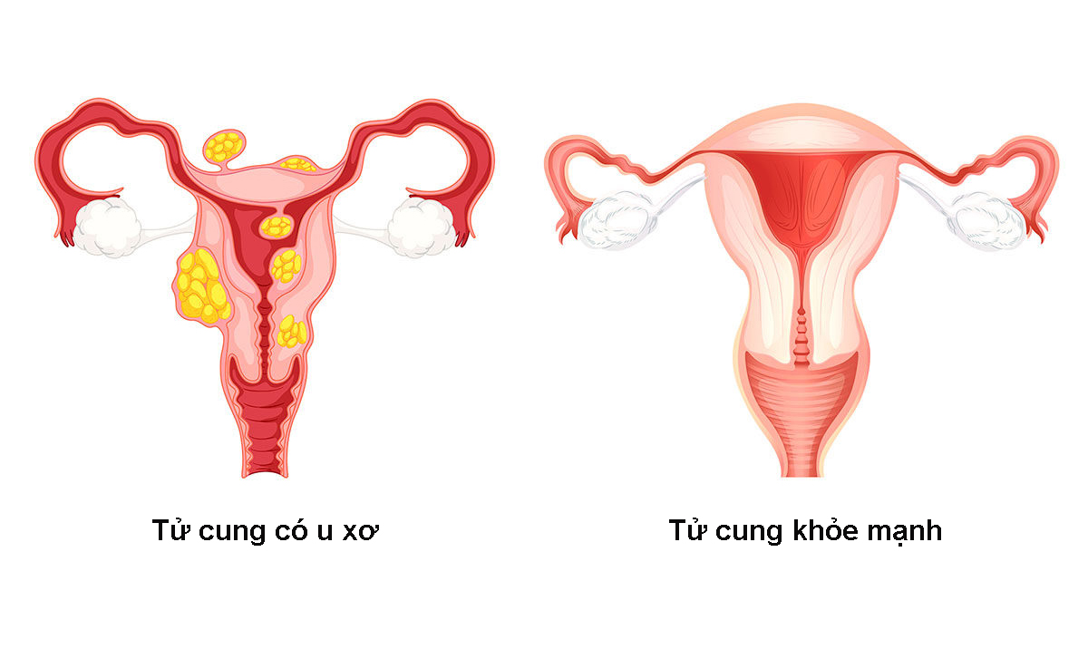 U xơ tử cung được hình thành từ sợi cơ trơn của tử cung do sự phát triển quá mức