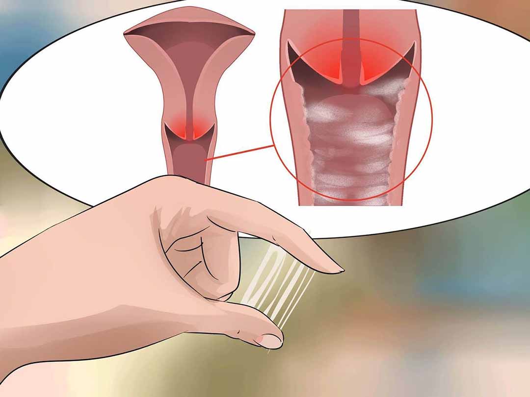 Viêm âm đạo là tình trạng ống nối giữa âm hộ và cổ tử cung của người phụ nữ bị viêm nhiễm