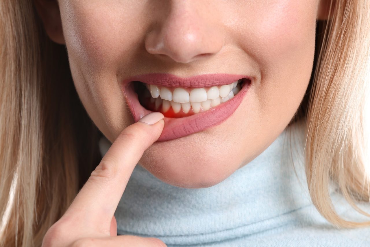 Chuyên gia giải đáp: Viêm chân răng làm sao hết? | TCI Hospital