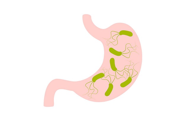 Viêm dạ dày có hp dương tính là tình trạng viêm dạ dày bị nhiễm khuẩn
