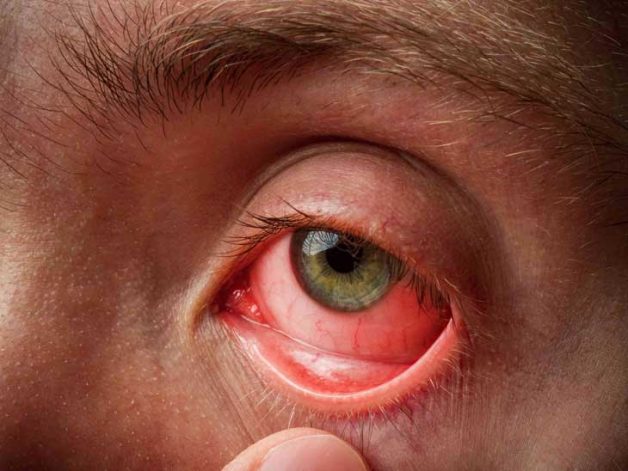 Đỏ mắt là một triệu chứng của viêm màng bồ đào mắt