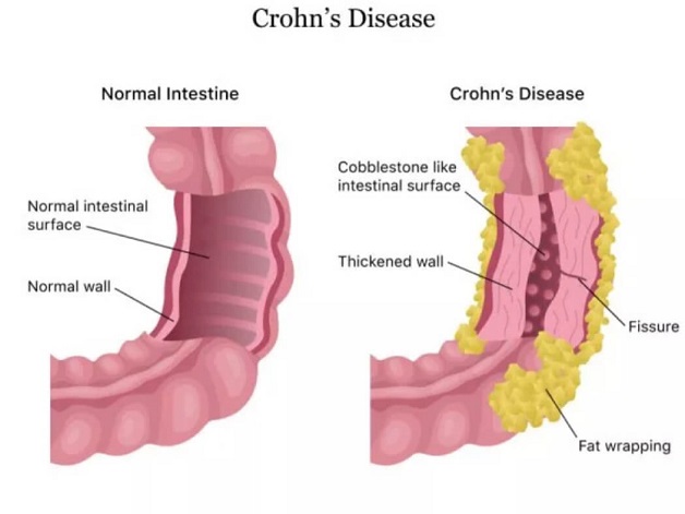 benh Crohn 1 1