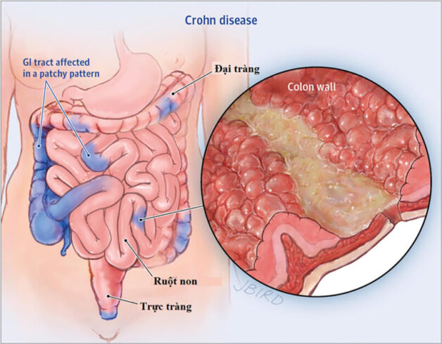 Điều trị bệnh Crohn bao gồm những phương pháp nào?
