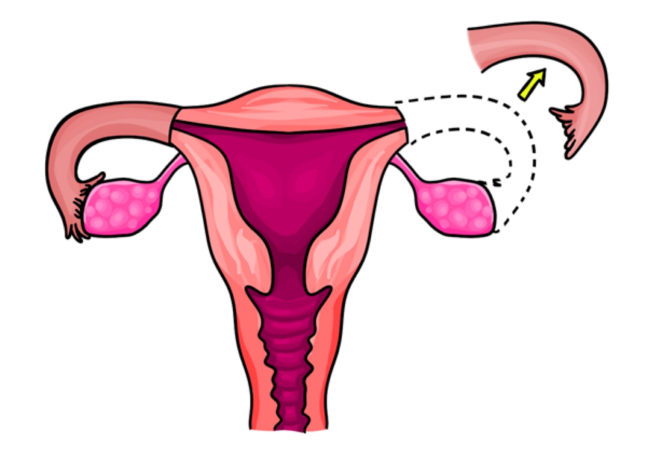 Bệnh lý chửa ngoài tử cung, phẫu thuật cắt vòi trứng phải có hiệu quả ra sao?