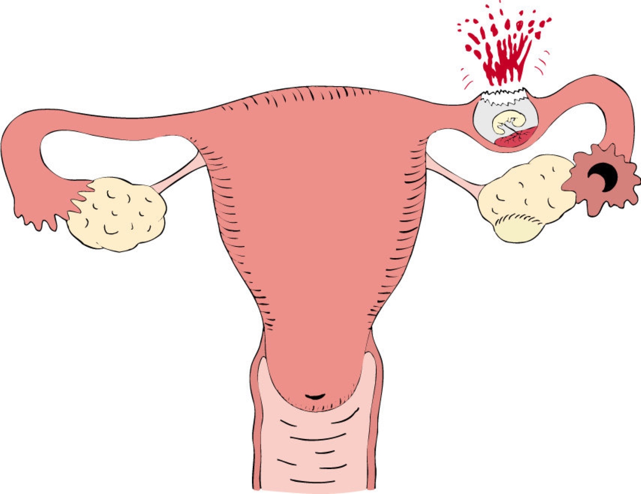 Без маточное беременность. Внематочная беременность разрыв маточной трубы. Внематочная беременность трубный разрыв. Внематочная (эктопическая) беременность. Патоморфология внематочной беременности.