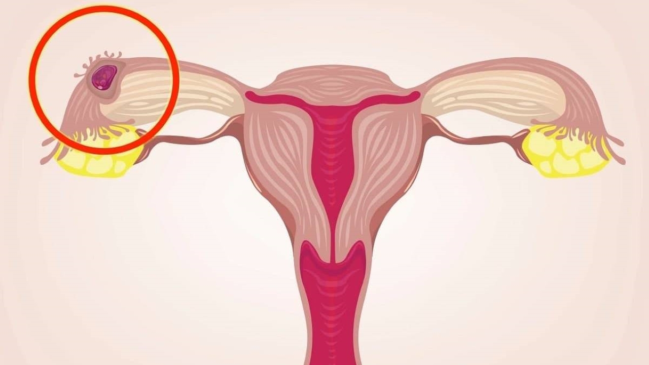 Tại sao bệnh nhân phải cắt vòi trứng khi mắc bệnh thai ngoài tử cung?
