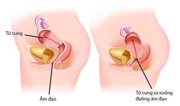 Hình ảnh tử cung bị sa biến chứng ảnh hưởng sức khỏe