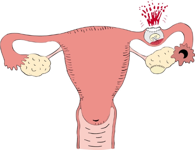 4. Các biến chứng và rủi ro tiềm ẩn