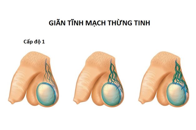 gian tinh mach thung tinh do 1 e1670231701432