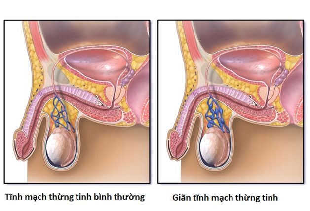 gian tinh mach thung tinh la gi e1670231212691