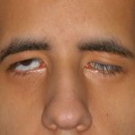 Bệnh mí mắt sụp, nguyên nhân gây mất thẩm mỹ và giảm thị lực