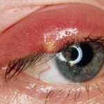 Ngứa bờ mi mắt, dấu hiệu của bệnh viêm bờ mi cần phải để ý