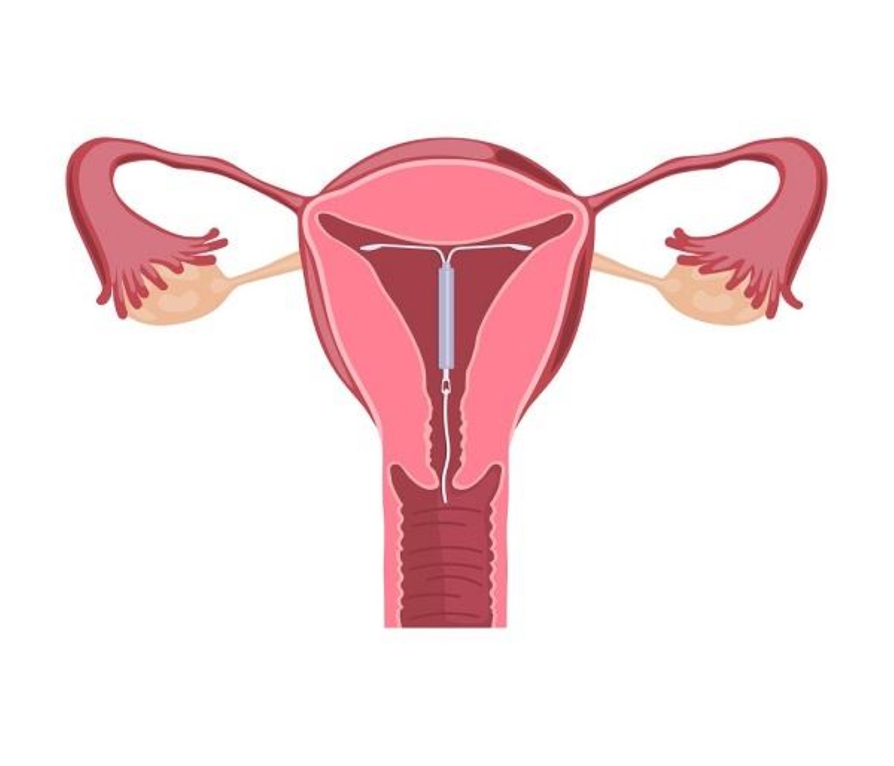 Đặt vòng tránh thai có những loại nào và nên lưu ý những gì