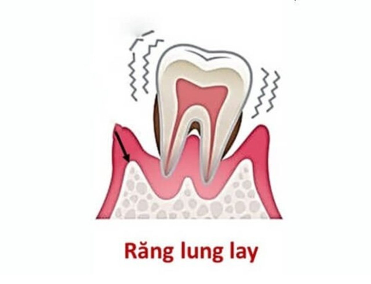 Phương pháp trồng răng giả là lựa chọn tốt nhất cho răng hàm lung lay?
