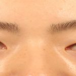 5 nguyên nhân sụp mí mắt và cách điều trị