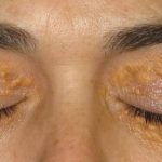 Bệnh u vàng mi mắt và những điều cần biết