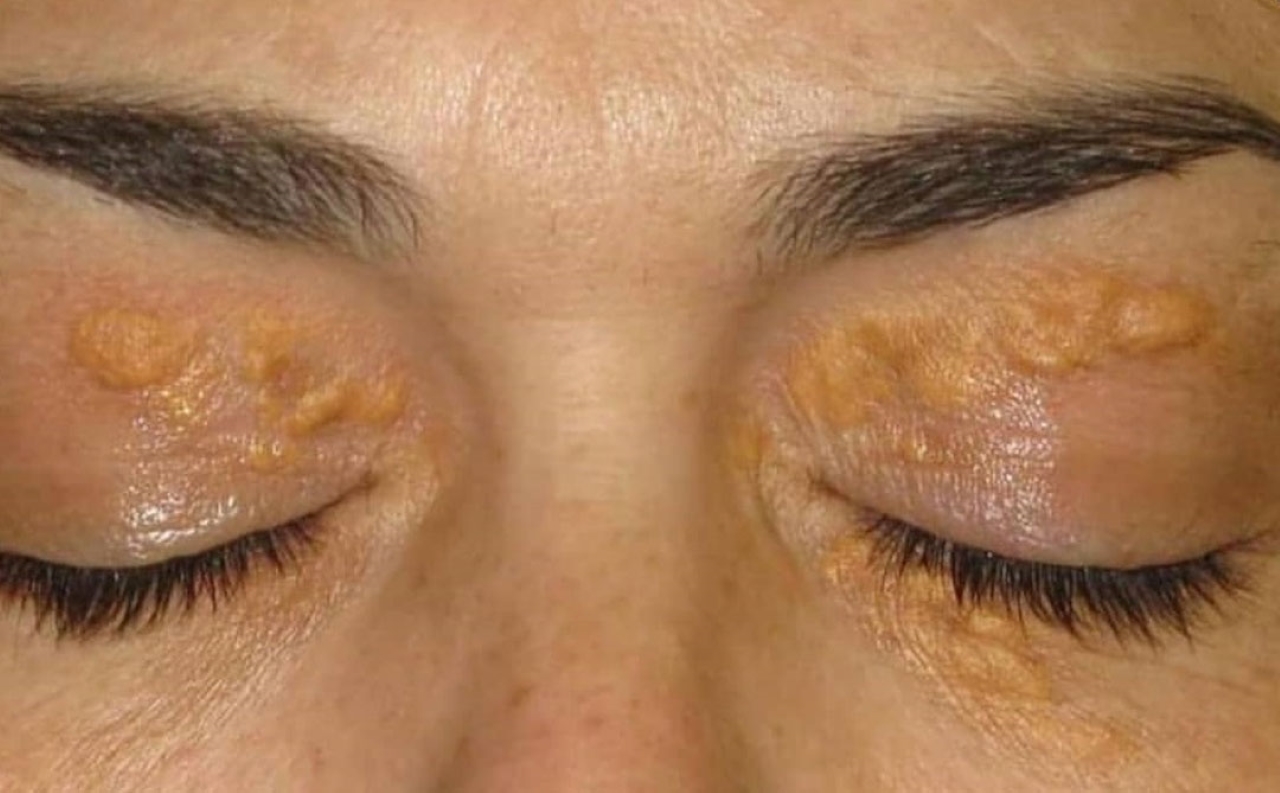 Bệnh u vàng mi mắt và những điều cần biết