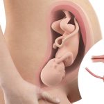 Phụ nữ bị u xơ tử cung có mang thai được không?
