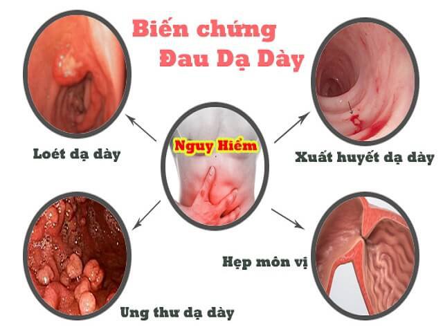 4. Các biến chứng nguy hiểm của viêm dạ dày