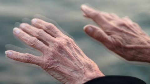 Bệnh Parkinson giai đoạn cuối có biểu hiện gì?