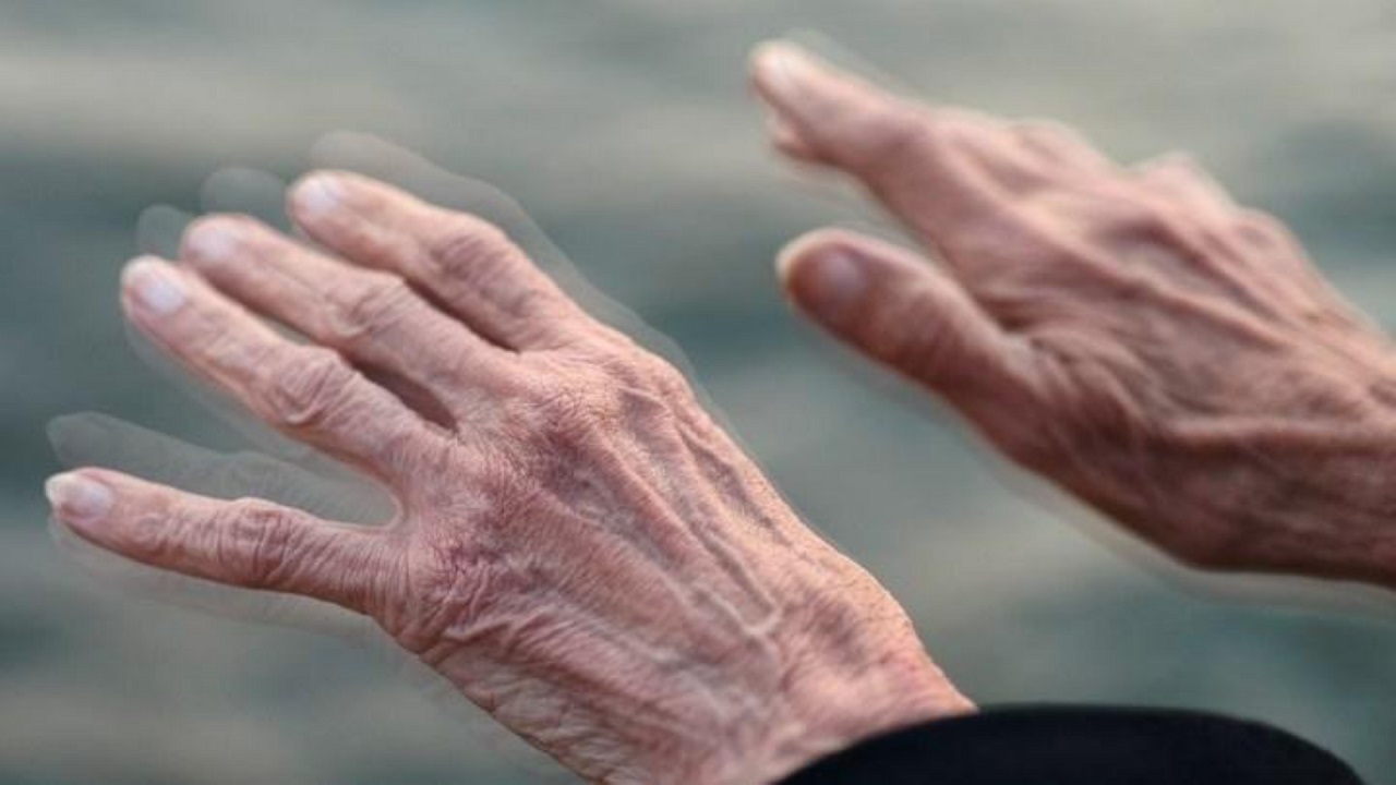 Bệnh Parkinson giai đoạn cuối diễn ra như thế nào?
