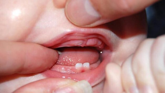 Sốt mọc răng ở trẻ: Cách nhận biết và xử trí | TCI Hospital