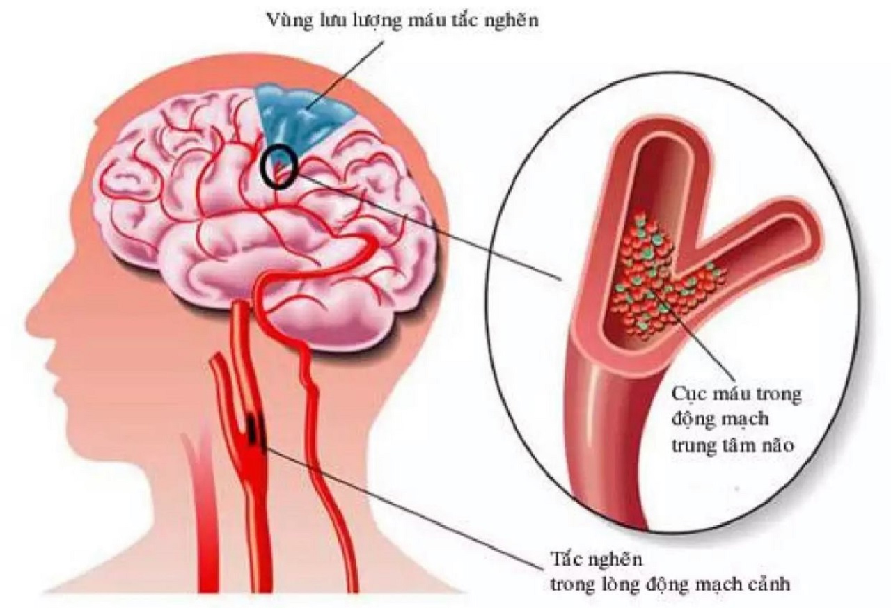 Táº¯c ngháº½n máº¡ch mÃ¡u nÃ£o: Äá»t quá»µ chá»±c chá»